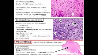 Mesencyhmal Tumors of the GI Tract Kurts Notes pathagonia [upl. by Oiznun747]