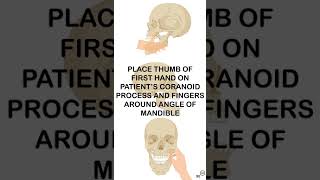 Extraoral mandible reduction animation [upl. by Howarth726]