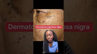 Why Do I Have These Dark Skin Spots Understanding Dermatosis Papulosa Nigra [upl. by Anauqahc]