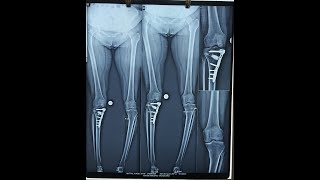 HTO HIGH TIBIAL OSTEOTOMY [upl. by Ynnel]