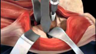 Depuy Direct Anterior Total Hip Replacement Animated Video [upl. by Couture505]