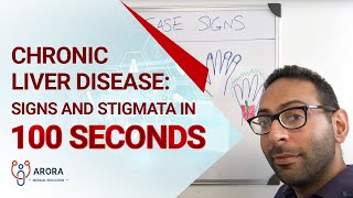 Chronic Liver Disease Signs and Stigmata in 100 seconds [upl. by Ahsetel]