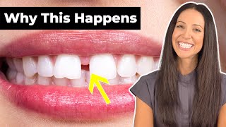 Why Do People Have GAP TEETH amp How To Fix It Diastema Explained [upl. by Lull117]