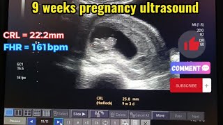 nine weeks pregnant scan video [upl. by Grati353]