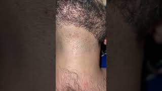 barber hairissue hair removingingrown hairproblem barbershop ingrownhair beard [upl. by Gebhardt]