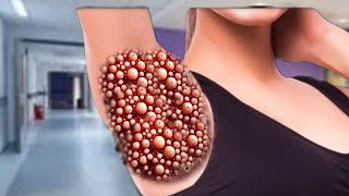 ASMR treatment from Infacted shoulder  ASMR Remove Trypophobia cleaning [upl. by Kirsti]