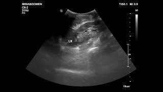 pleural fibrous tumor [upl. by Iow]