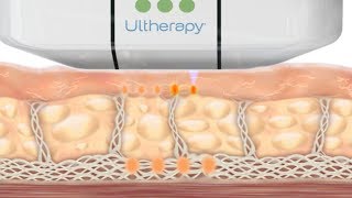 How the Ultherapy Treatment Works [upl. by Merna]