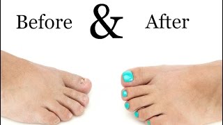 Toenail Treatment  Miracle Gelous Reconstruction [upl. by Leonid]