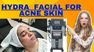 quotHydra Facial and AcneThe Ultimate Solution for Clearer SkinquotHydraFacial AcneTreatmentlookssalon [upl. by Hanikas]