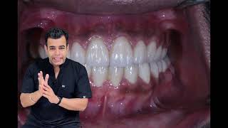 Pathological tooth migration मेरे सामने के दांत धीरेधीरे फैल गए हैं  Drifting of Teeth [upl. by Mahseh]