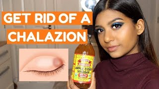 HOW TO GET RID OF A CHALAZION FAST AT HOME [upl. by Llewkcor]