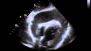 Echocardiography with a Significant Pericardial Effusion [upl. by Morganne]