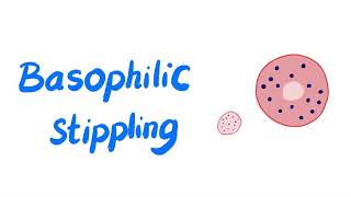 Basophilic Stippling of RBCs  Lead Poisoning  Microscopic Finding  Hematology Labs [upl. by Luaped]