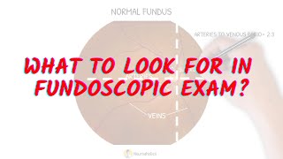 What to look for in fundoscopic exam Neuroaholics [upl. by Zertnom]