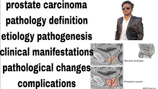 prostate carcinoma  prostate cancer  pathology notes  definitionetiologypathogenesishindi [upl. by Eelsha]