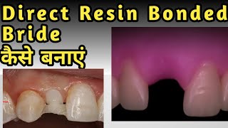 Direct Resin Bonded Bride कैसे बनाएं [upl. by Marcellina]