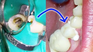 Full Root Canal amp Crown Procedure w Post amp BuildUp Placement Process Dental Treatment On A Molar [upl. by Fransis]