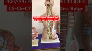 Cervical Problem amp Lower Back Pain Treatment shorts sciatica neckpain [upl. by Aekal]