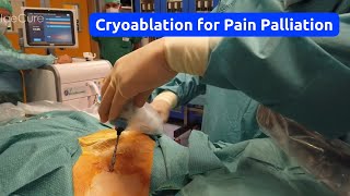 Palliative Cryoablation for Pain Management Using the ProSense™ System [upl. by Stannwood]