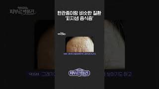 한관종이랑 비슷한 질환 피지샘 증식증 피부과 한관종 피지샘증식증 [upl. by Sapphire]