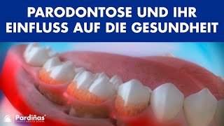 Parodontose und ihr Einfluss auf die Gesundheit © [upl. by Swanson]