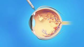 US Ophthalmic Retina Macular Edema Injection [upl. by Stoecker]