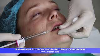 Tratamentul buze cu acid hialuronic de hidratare [upl. by Marl140]