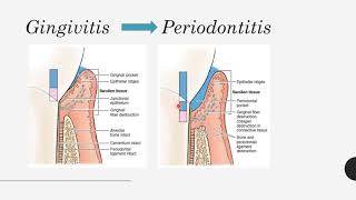 Progression of periodontal disease alias perkembangan penyakit periodontal [upl. by Cheng]