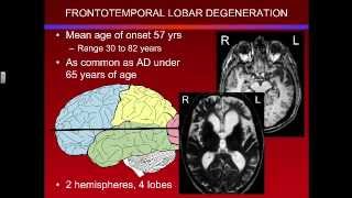 Overview of Frontotemporal Lobar Degeneration [upl. by Atirhs]