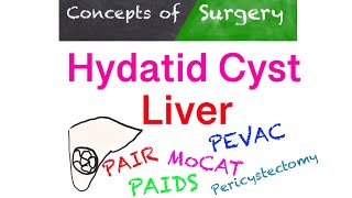 Hydatid Cyst Liver simplified treatment strategy [upl. by Reinaldo730]