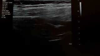 suprascapular nerve block 24110101 [upl. by Malynda]