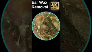 New Video Ear Wax Removal 1021 shorts earwax [upl. by Gibby]