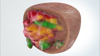 Tumour heterogeneity in prostate [upl. by Wooster]