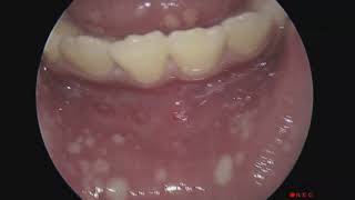 Severe Mouth and Throat Pain Caused By Herpes Infection [upl. by Einial]