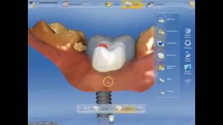 Coroane dentare si bont protetic realizate digital intro singura sedinta cu Cerec CadCam [upl. by Annehsat392]