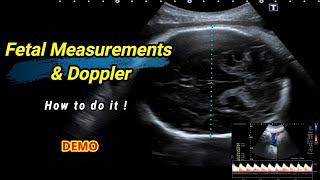 Fetal measurements and Doppler  How to do it [upl. by Acirat270]