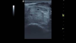 Goiter nodular 갑상선종 결절성2 [upl. by Akcinehs252]