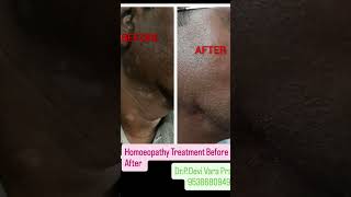 homoeopathy skin skincare DrPDevi Vara Prasad PAGADALA HOMOEO CARE 9538680949KHAMMAM [upl. by Tsuda111]