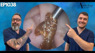 Satisfying Ear Wax amp Skin Removals  EP1038 [upl. by Ghassan]