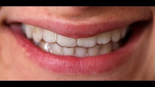 Clear Aligner  Erfahrungen mit unsichtbaren Zahnspangen wwwzahnspangende [upl. by Melak]