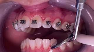 Why did i only get braces on my top teeth  Tooth Time Family Dentistry New Braunfels Texas [upl. by Cida]