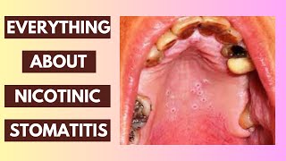 Nicotinic Stomatitis Explained Causes Symptoms and Treatment Options  InDepth Lecture [upl. by Ailemak]