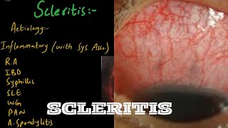 SCLERITIS  Diference between Scleritis and Episcleritis  Part 2 [upl. by Arleyne]