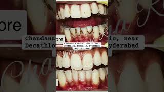 World’s first dental spa Kompally Hyderabad  telugu dentist hyderabad smile smilemakeover [upl. by Kotick]