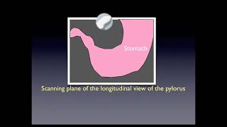 Pyloric Stenosis [upl. by Nader]