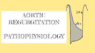 Aortic regurgitation pathophysiology [upl. by Donoho]