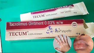 Tecum 003 ointment review। Tacrolimus ointment 003 ww। Leucoderma। Vitiligo। सफ़ेद दाग [upl. by Ferdinana339]