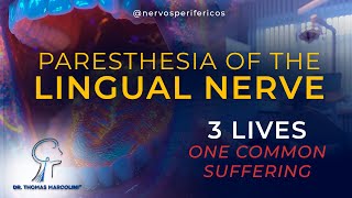 Lingual Nerve Paresthesia  Real Stories Complete Documentary [upl. by Marlon]