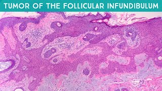 Tumor of the follicular infundibulum TFI  dermpath in 5 minutes dermatology pathology [upl. by Eirrem100]